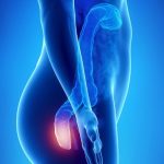 Αντιμετώπιση αιμορροϊδων