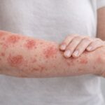 Φυσική αντιμετώπιση ψωρίασης