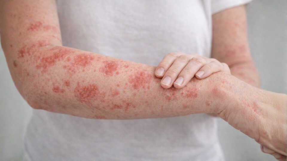 Φυσική αντιμετώπιση ψωρίασης