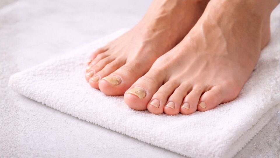 Πως να αντιμετωπίσετε φυσικά την Ημικρανία